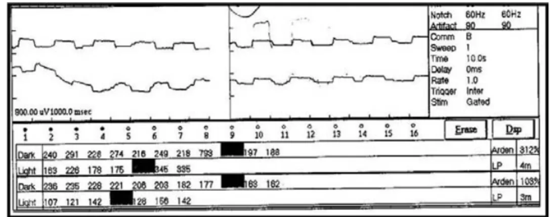 Fig. 5. Electro-oculograma.