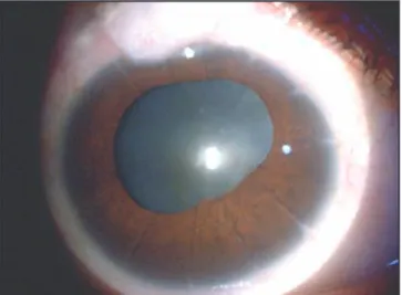 Fig. 5. Paciente pseudofaco con queratotomía radiada previa.