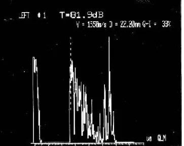 Fig. 7. Tomografía de la lesión orbitaria izquierda.