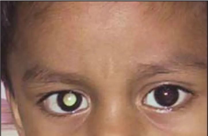 Fig. 1. Leucocoria en ojo derecho.
