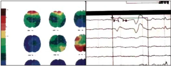 Fig. 2. Videograbación con luz infrarroja para demostrar las diferentes fases de la versión horizontal con fenómeno de ganancia y retraso clínico de movimiento en el ojo no ocluido que viaja hacia fuera.