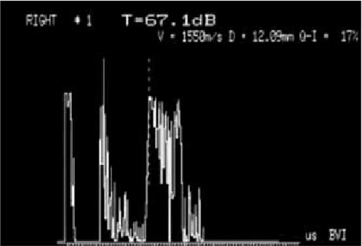 Fig. 5. Ecograma  A, mostrando reflectividad interna baja, que