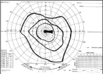 Fig. 2. Campo visual del ojo derecho en que se observa un escotoma centrocecal.