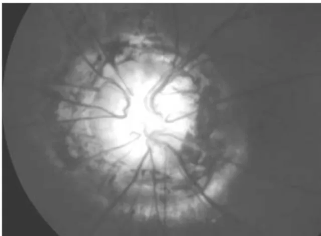 Fig. 2. Alteraciones en la movilidad ocular: endotropia de ángulo variable con hiperfunción de los cuatro músculos oblicuos.