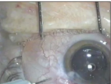 Fig. 2. Vitrectomía calibre 25.