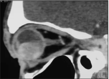 Fig. 4. TAC lateral de cráneo simple en que se observa una lesión
