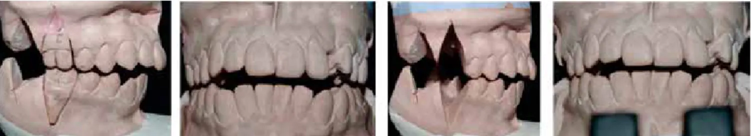 Figure 5. Diagnostic setup. Initially, second molars were eliminated with no success. By extracting the first molars a decrease 