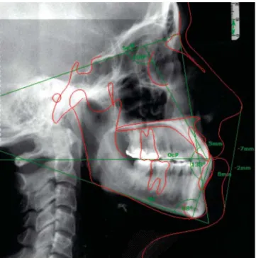 Figura 1. Cefalografía lateral inicial.