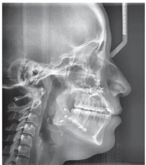 Figura 12. Osteotomía Le Fort I, se ven las placas de fi ja-