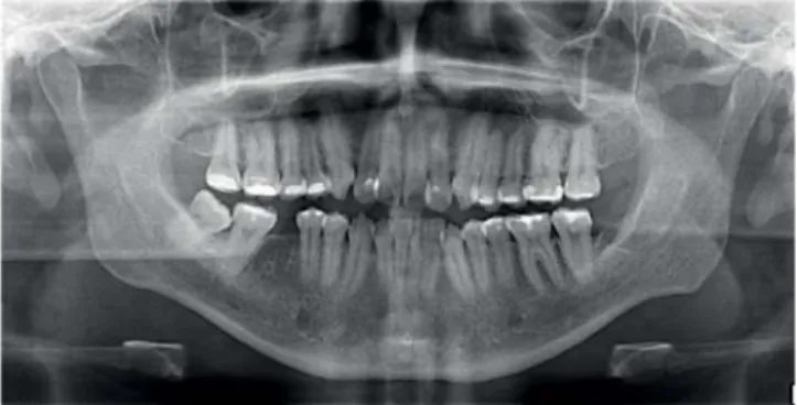 Figure 3. Initial lateral headfi lm.