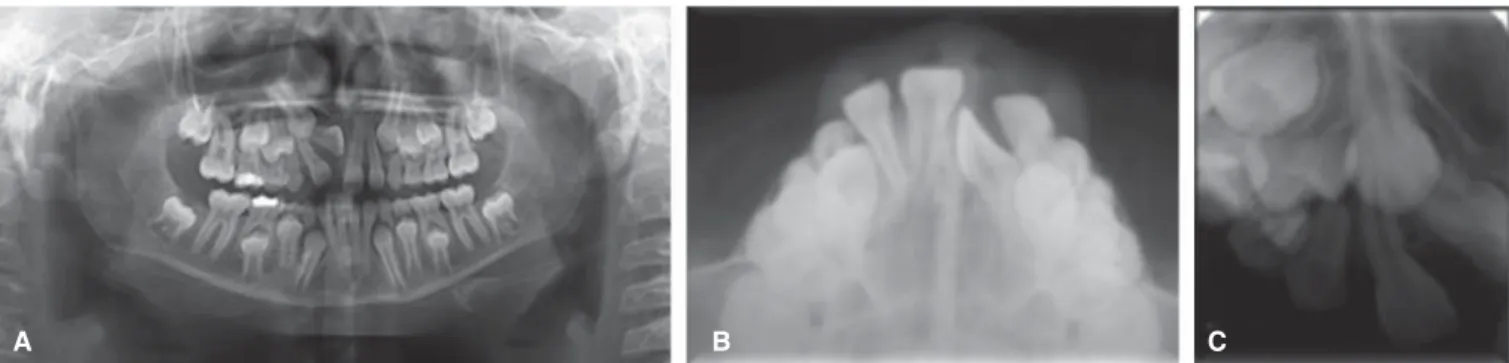 Figure 3. Initial radiographs. A) Panoramic radiograph: the impaction of the upper right central incisor in a horizontal position 
