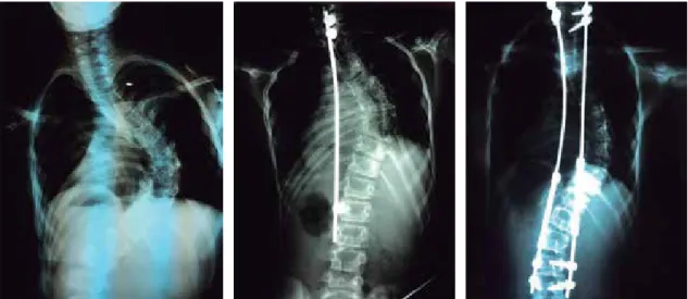 Figura 1. Radiografía anteroposterior de columna, con escoliosis infantil de inicio temprano, tratada con una barra de crecimiento 