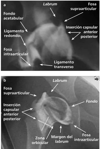 Figura 3. Fotografía clínica demostrando los sitios  anatómicos a considerar; en el recuadro se observa la  asistencia del intensificador y el sitio de punción ubicado en  el extremo superior y lateral del cuello femoral, distal a la  físis proximal del fé