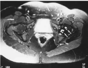 Figura 8. Resonancia magnética con gadolinio después de  una reducción cerrada de la cadera izquierda, se observan  cambios en la intensidad de la señal en múltiples porciones  de la cabeza, indicando hipoperfusión global.