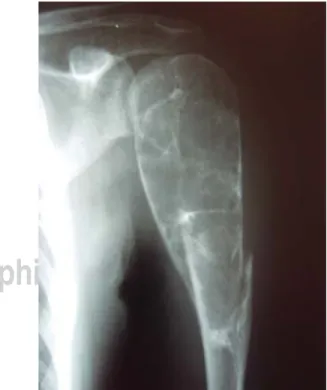 Figura 1. Imagen de radiología convencional de quiste óseo  simple del húmero proximal.