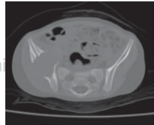 Figura 6. Corte axial de tomografía. Lesión pélvica de  granuloma eosinófilo.