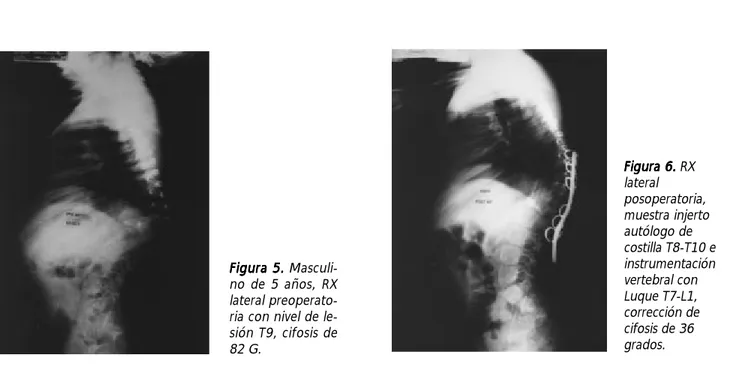 Figura 5.Figura 5.Figura 5.Figura 5. Figura 5.  Masculi-no de 5 años, RX lateral  preoperato-ria con nivel de  le-sión T9, cifosis de 82 G