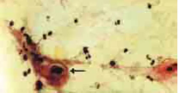 Figura 1. Coilocito maligno en forma de renacuajo, que