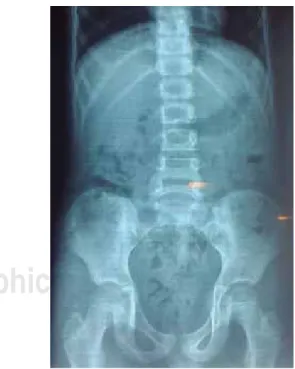 Figura 1. Radiografía simple de abdomen, de pie. Se observa 