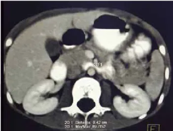 Figura 4. Tomografía computarizada abdominal contrastada en 