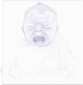 Figura 3. Expresión facial de un niño con cólico del lactante.