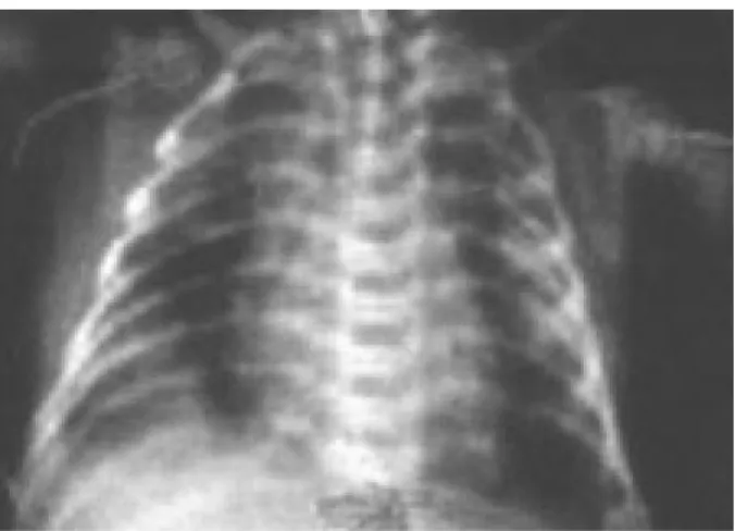 Figura 1. Radiografía de tórax: presencia de infiltrado