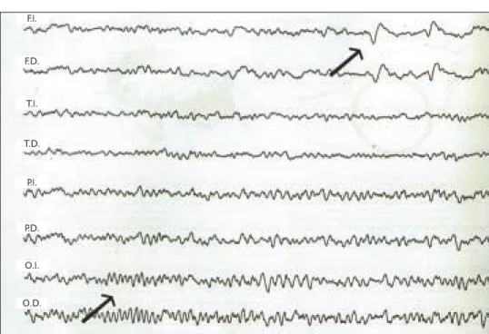 Figura 1. Electroencefalograma