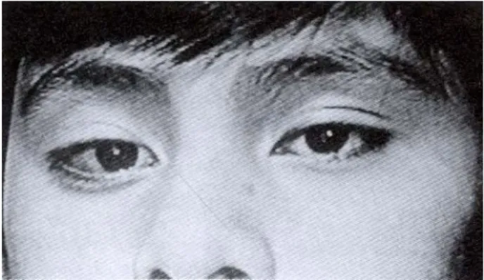 Figura 7. Paciente con endotropia y cardiopatía congénitas.