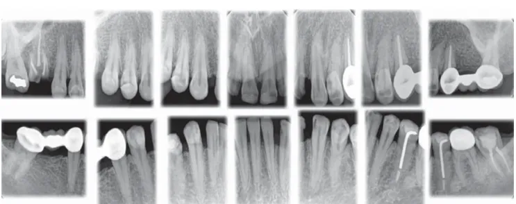 Figura 5. Estudio radiográfi co periapical.