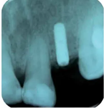 Figura 12. Colocación de implante dental 6 meses después de ROG.Figura 11. A dos meses de cicatrización después del ITC.