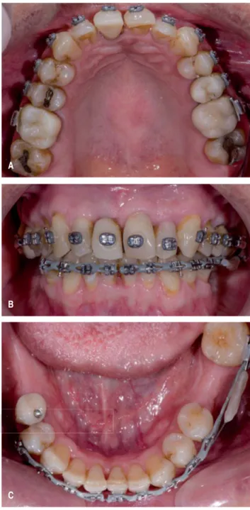 Figura 2. A. Vista oclusal superior cuatro meses después. B. 