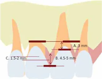 Figura 1. A. Complejo dentogingival. B. Llenado papilar. C. UCE mesial y distal del central derecho.