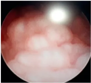 Figura 1. Hallazgos de cistoscopia