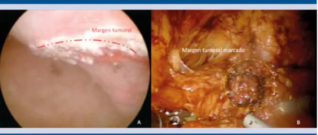 Figura 3.  Delimitación del borde quirúrgico tumoral con energía monopolar por cistoscopia ( A ) y laparoscopia ( B ).
