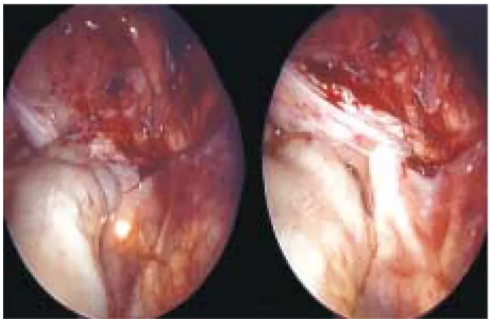 Figura 5. Vista laparoscópica de la pelvis de un