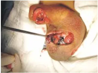 Figura 5. Caso 2: Destrucción testicular izquierda.