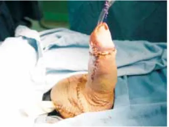 Figura 6. Caso 2: Lesión de uretra y cuerpos cavernosos. Colgajo pediculado de piel de  prepu-cio para reconstrucción uretral.