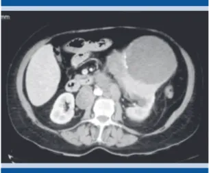 Figura 1.  Tomografía de abdomen, corte axial, que  muestra el riñón izquierdo con aumento de tamaño  (20 × 17 × 14 cm), bordes regulares y calcificaciones.