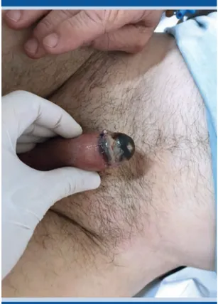 Figura 3.  Necrosis  húmeda  del  glande  (día  15  po- po-soperatorio), con exudado purulento en la línea de  sutura quirúrgica.