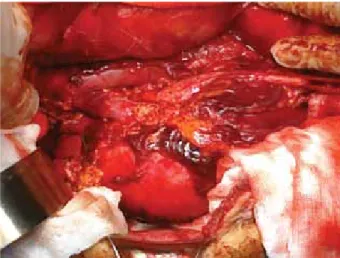Figura 3. Se realizó sutura de arteria apical y rafia de polo renal 