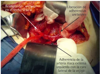 Figura 2.  Fotografía transoperatoria de la cirugía pélvica, donde se ob-