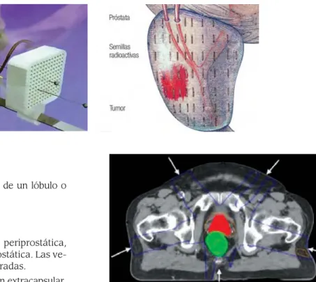 Figura 9. Radioterapia conformacional.