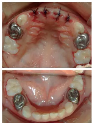 Figure 4. All teeth isolated during procedure of general 