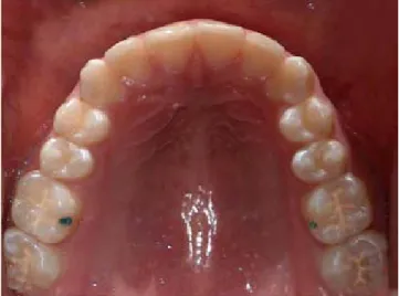 Figura 6. Fotografía intraoral oclusal inferior donde se ob-
