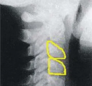 Figura 4. Cefalograma de vértebras cervicales.