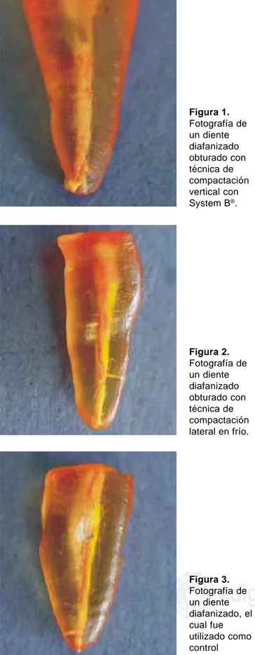 Figura 2. Fotografía de un diente diafanizado obturado con técnica de compactación lateral en frío.