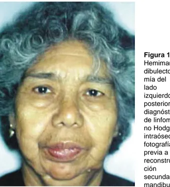 Figura 1.  Hemiman- dibulecto-mía del lado izquierdo posterior a diagnóstico de linfoma no Hodgkin intraóseo, fotografía previa a la  reconstruc-ción secundaria mandibular.
