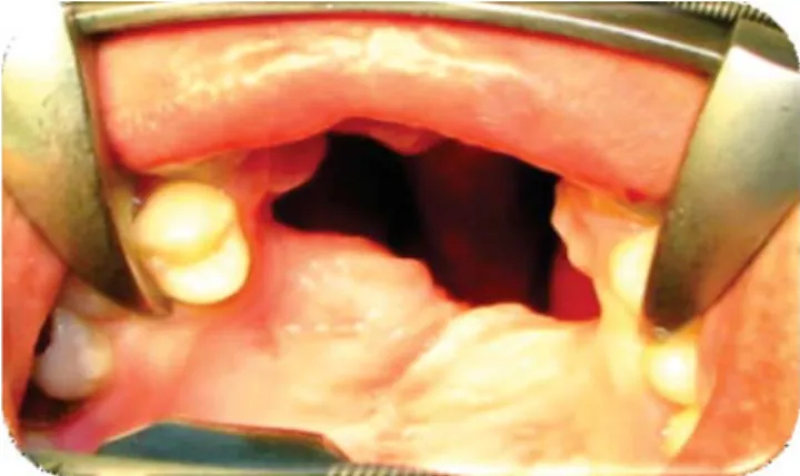 Figure 1. Initial intra-oral photograph. Anterior palatal fi stula 