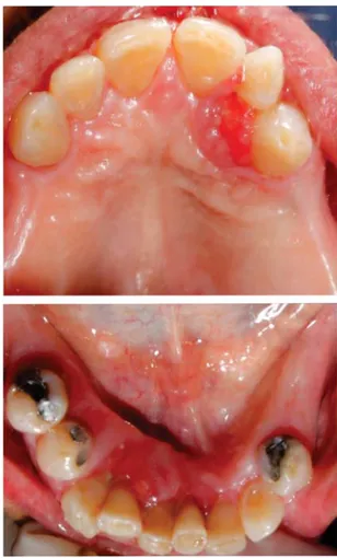 Figura 1. Vista frontal: periodontitis crónica generalizada y  agrandamiento gingival a nivel de pieza 2.1.