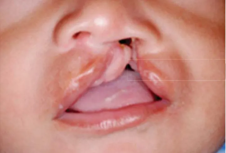 Figure 10B. After four weeks of treatment, the fi ssure was 
